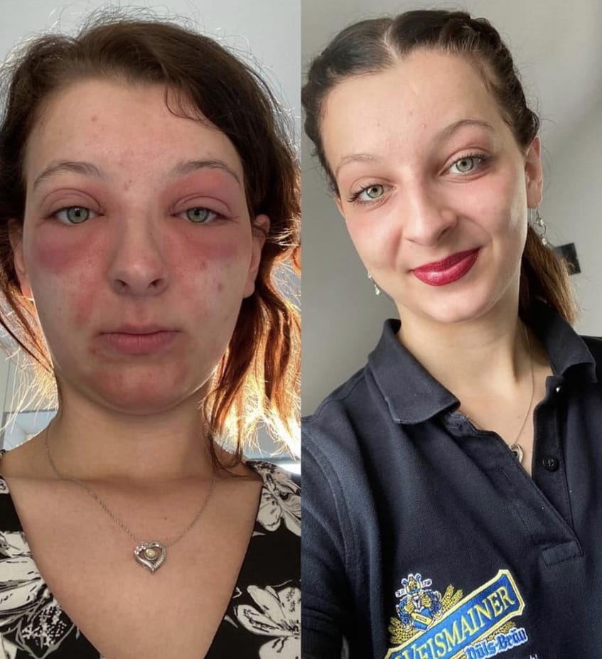 Linkes Bild: Frau mit gereizter Haut und gerötetem Gesicht. Rechtes Bild: Gleiche Frau lächelt.
