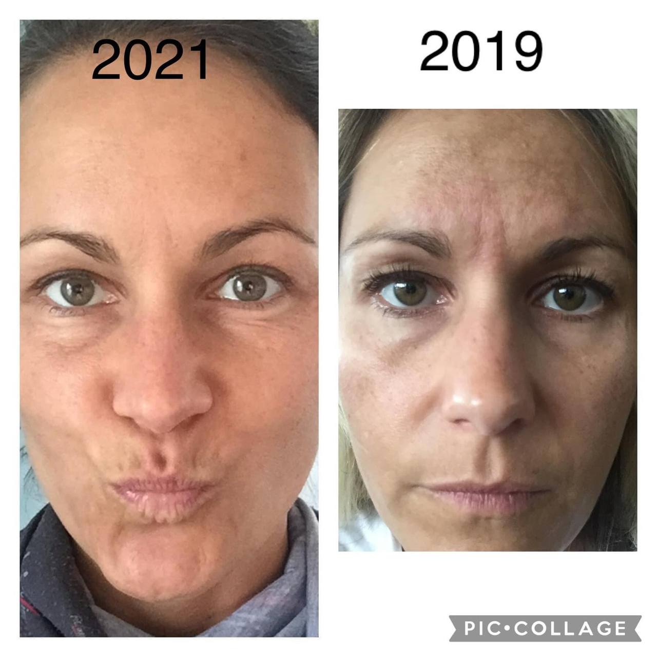 Zwei Bilder derselben Frau: 2021 mit Gesichtsausdruck vs. 2019 neutral, Hautveränderungen sichtbar.