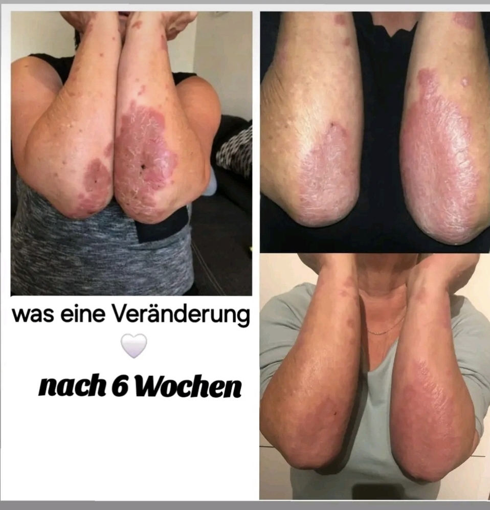 Zwei Vergleichsbilder: Rote, schuppige Ellbogen, vorher und nach sechs Wochen, verbessert.